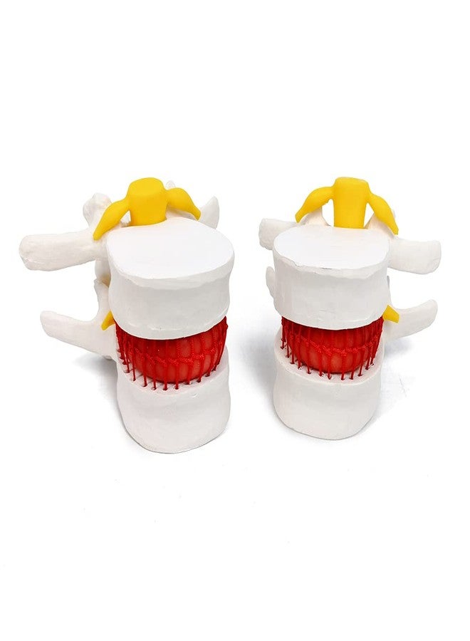 EVOTECH SCIENTIFIC Human Herniated Disc Model, Anatomical Herniated Lumbar Vertebrae Disc Prolapse Model for Medical Teaching Learning, Education Display Tooling, Student Learning Education Display Tool 3 Pack - Image 1